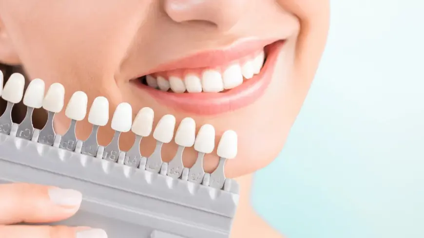 E-Max Veneers: The Perfect Blend of Strength and Aesthetics