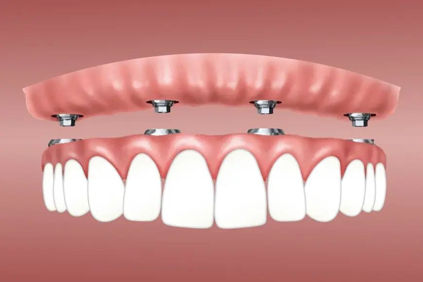 Dental Implants At PearlDentalclinics