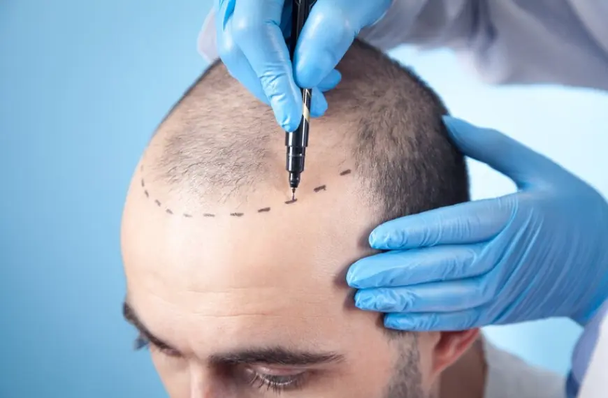 Hair Loss Clinic London – Want Hair Ltd Announces Breakthrough Techniques for Thinning Hair