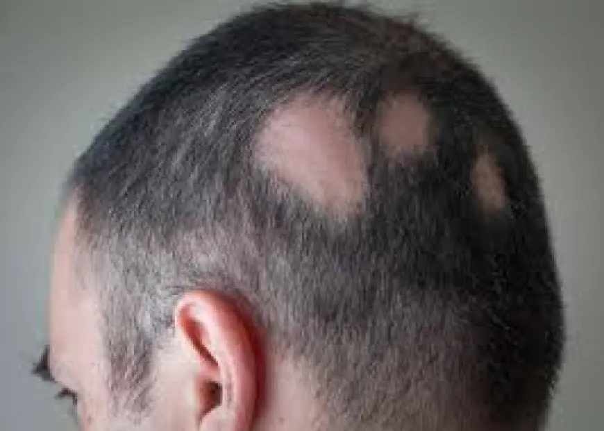 Alopecia Areata Treatment in Islamabad – Advanced Solutions for Hair Regrowth