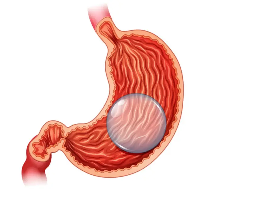 Gastric Balloon Placement Procedure