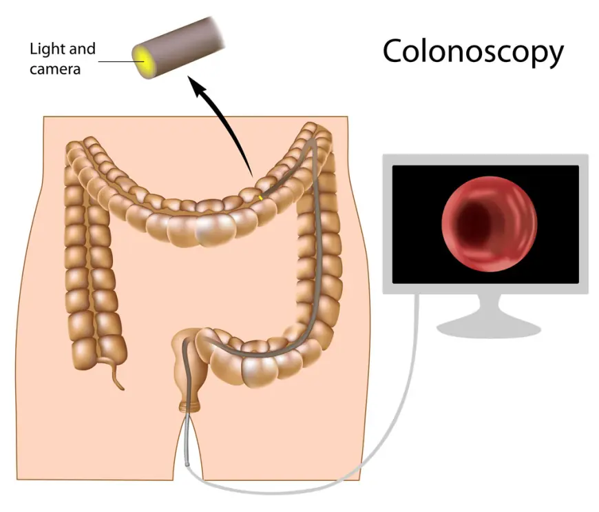 Colonoscopy Screening Singapore: A Guide to Preparation and Recovery