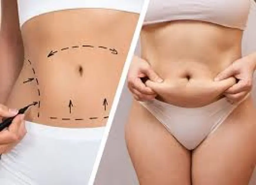 Abdominoplasty in Islamabad – Regain a Flat and Confident Abdomen