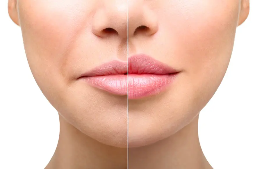 The Booming Dermal Fillers Market: Trends, Insights, and Future Outlook