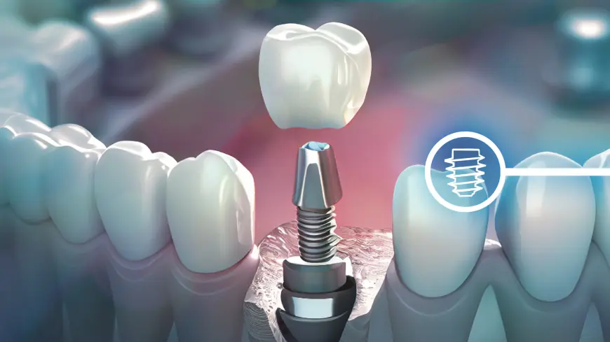Common Myths About Dental Implants Debunked