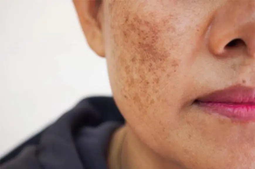 What Is the Best Pigmentation Treatment for Dark Spots?