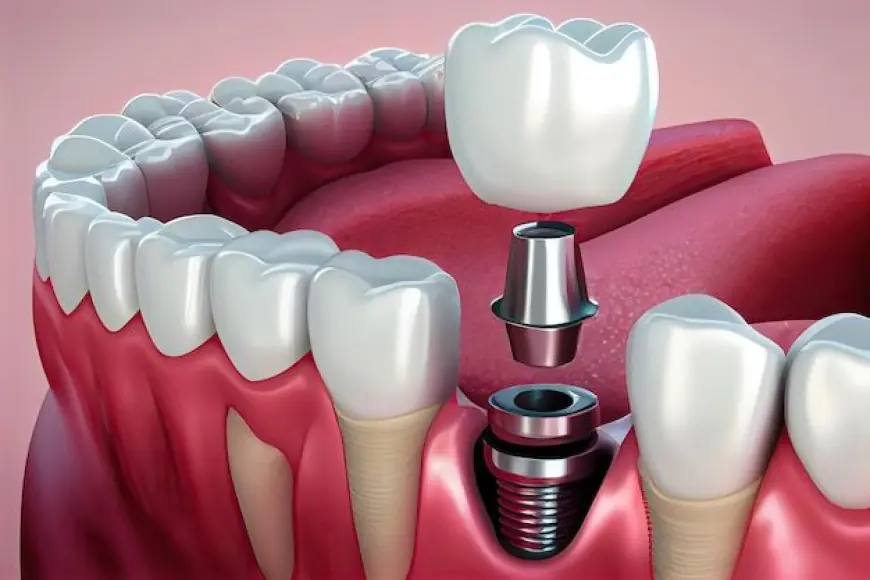 Understanding the Value of Dental Implants: A Long-Term Investment in Your Oral Health