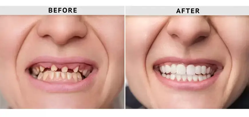 Trusted Dental Restorations for a Confident Smile