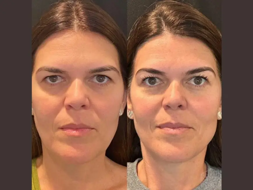 Thread Lift Treatments in Dubai: PDO Threads vs. Other Options