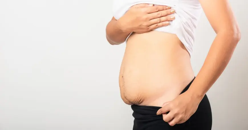 Can Tummy Tuck Surgery Fix Loose Skin After Weight Loss?