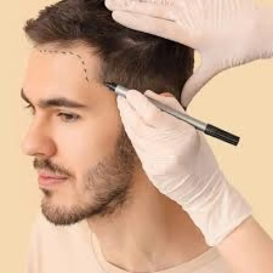 Best PRP Hair Treatment in Islamabad – A Natural Way to Restore Hair