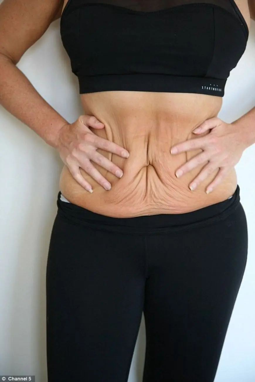 Preparing for Liposuction in Riyadh – What You Need to Know
