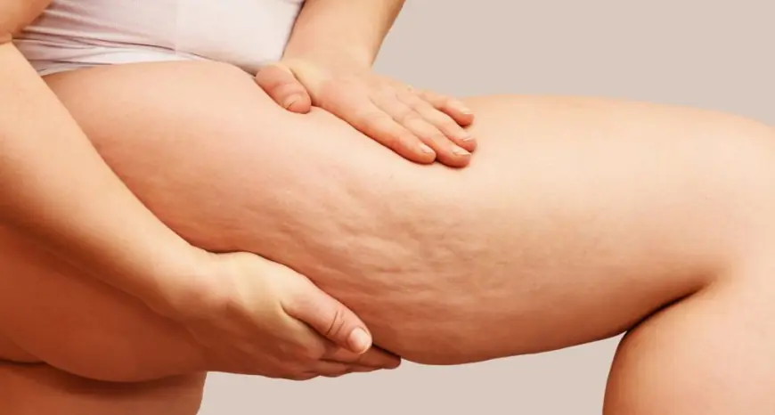 Can Cellulite Treatment Help with Aging Skin Conditions?