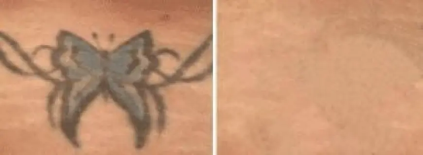 Can Old or Faded Tattoos Be Removed More Easily with Laser Tattoo Removal?