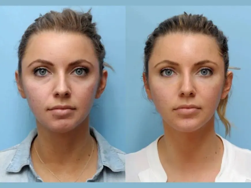 Thread Lift Performed Safely and Effectively by the Best Doctors in Dubai