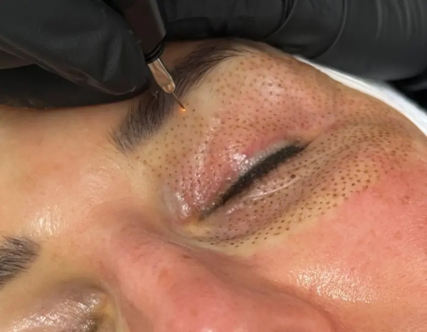 How Effective Is Plasma Pen Treatment for Skin Tightening?