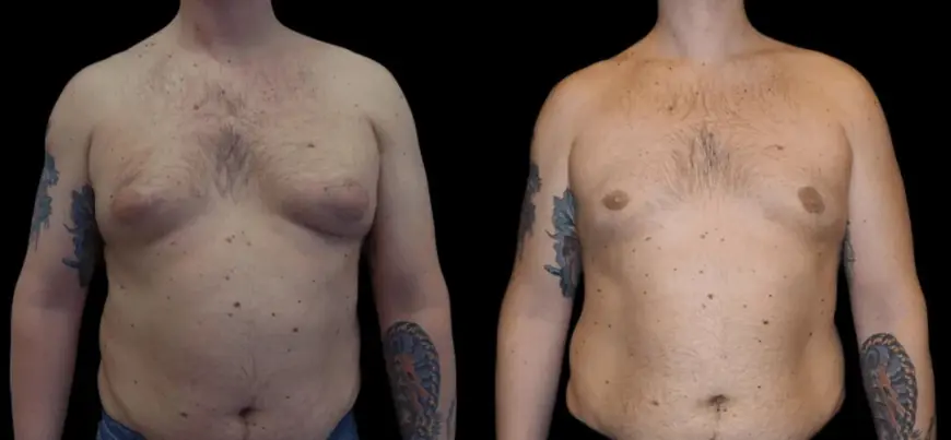 Best Gynecomastia Surgeons in dubai: Excellence in Gynecomastia Surgery