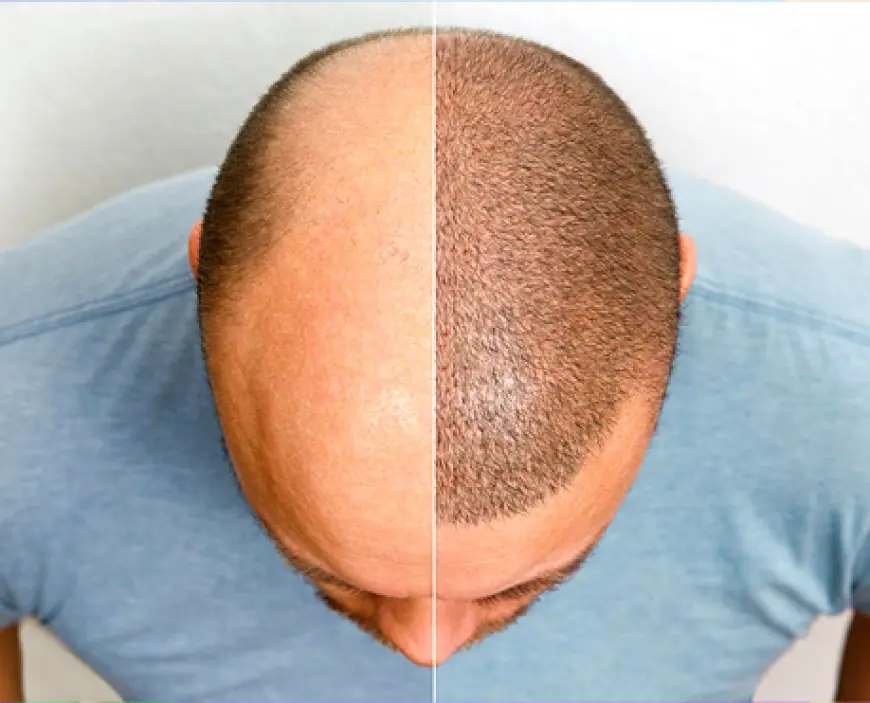 Which Hair Transplant Method Is Best in Dubai: FUE or FUT?