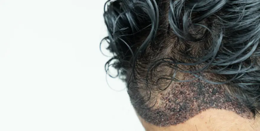 Strip Hair Transplantation in Dubai: Transform Your Look Today