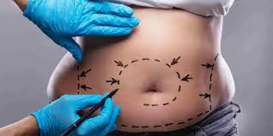 Is a Mini Tummy Tuck Suitable for Minor Belly Fat?