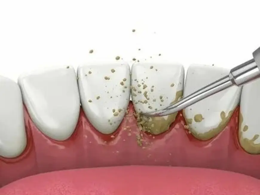 Teeth Cleaning and Polishing in Islamabad – Brighten Your Smile with Expert Care