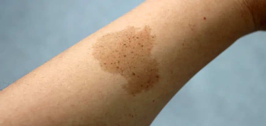 Birthmark Removal in Dubai: Post-Treatment Care for Best Results