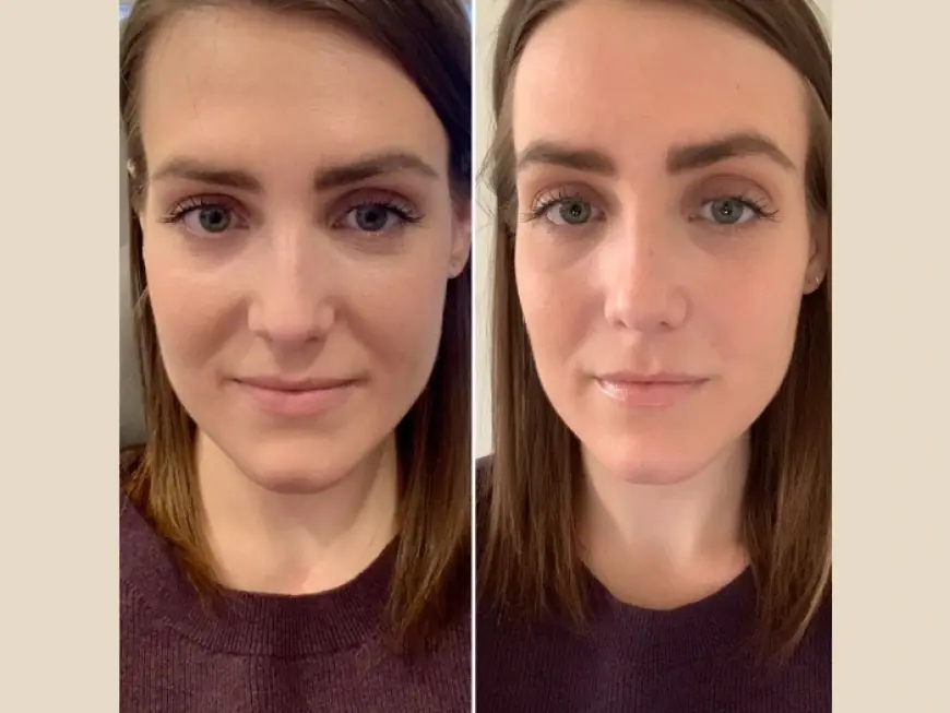 Best Doctors in Dubai for PRP Treatment: Natural Skin Glow