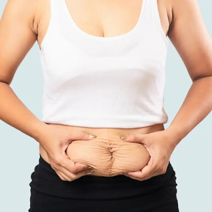 Can a Tummy Tuck Correct Stubborn Belly Fat Permanently?