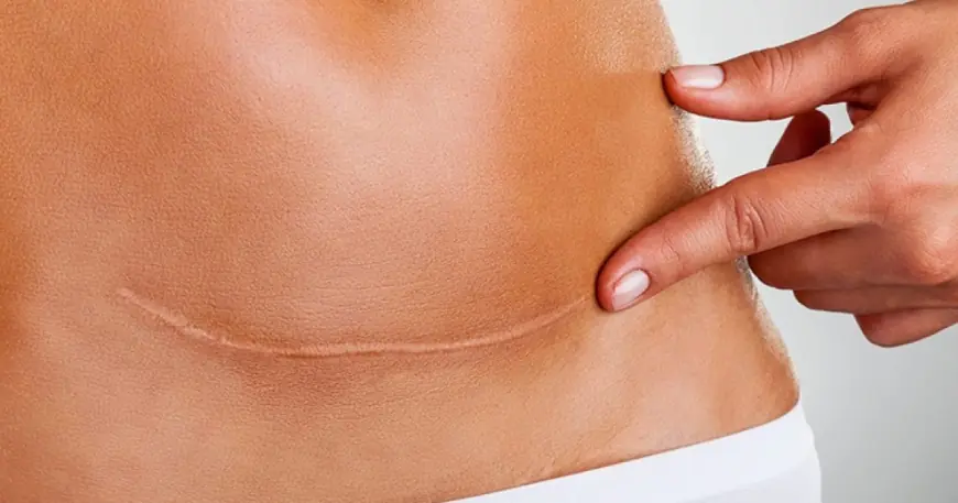 Scar Removal in Dubai: What Makes Clinics Here Stand Out