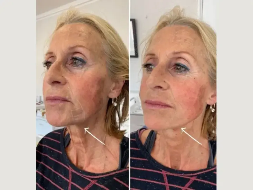 Combining Skincare with Endolift at the Best Aesthetic Clinics in Dubai