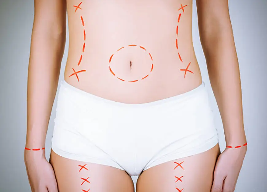 Benefits of Choosing Lipo Abdominoplasty for Waist Reduction