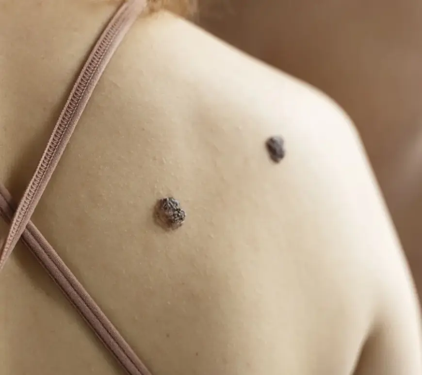 Are Multiple Sessions Needed for Birthmark Removal?