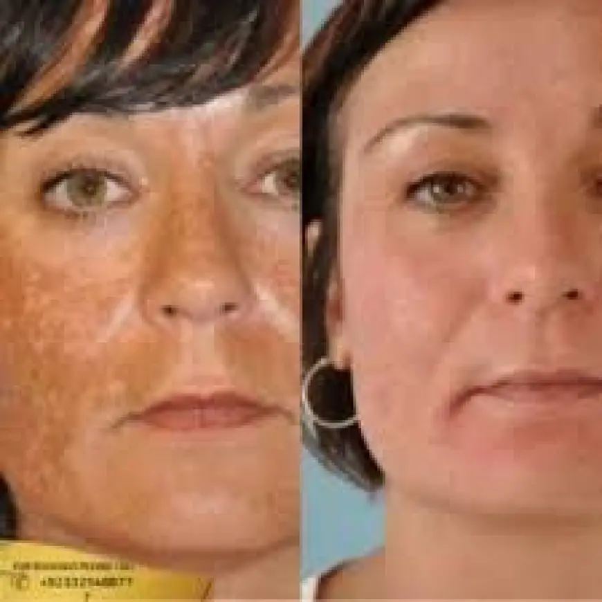 What to Expect from Melasma Treatment in Islamabad