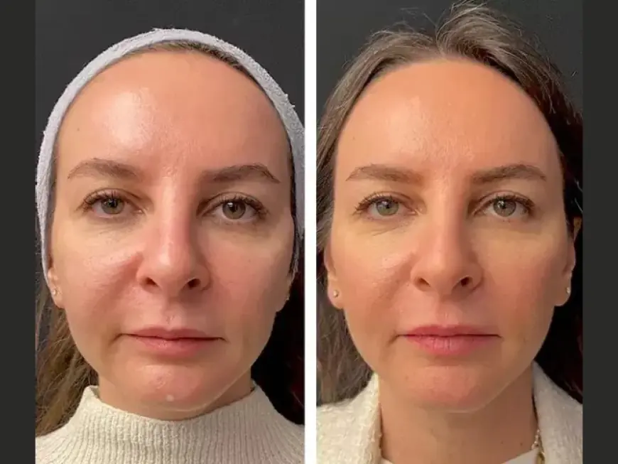 Mesotherapy treatment in Dubai: The Celebrity Beauty Secret