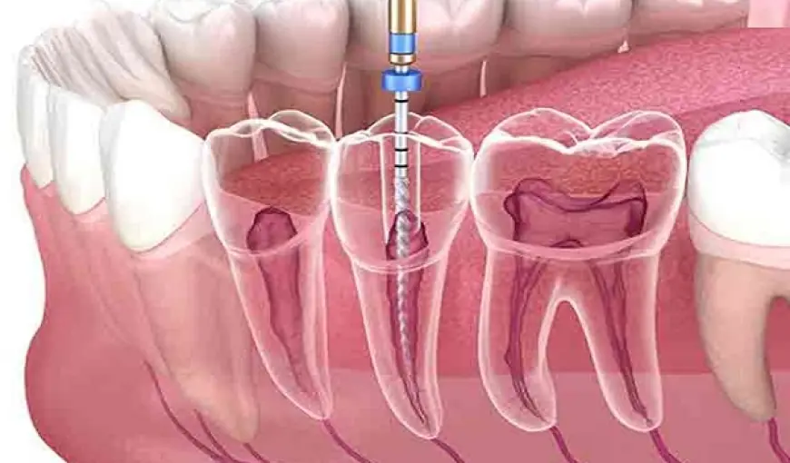 How to Save Money on Root Canal Treatment in Islamabad