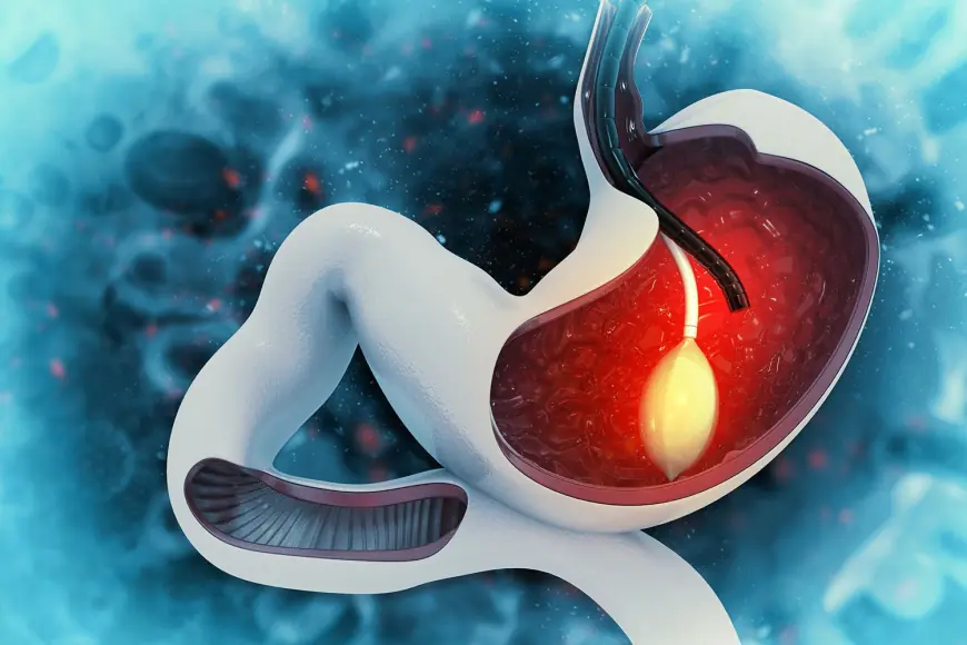 How Long Gastric Balloon Placement Lasts