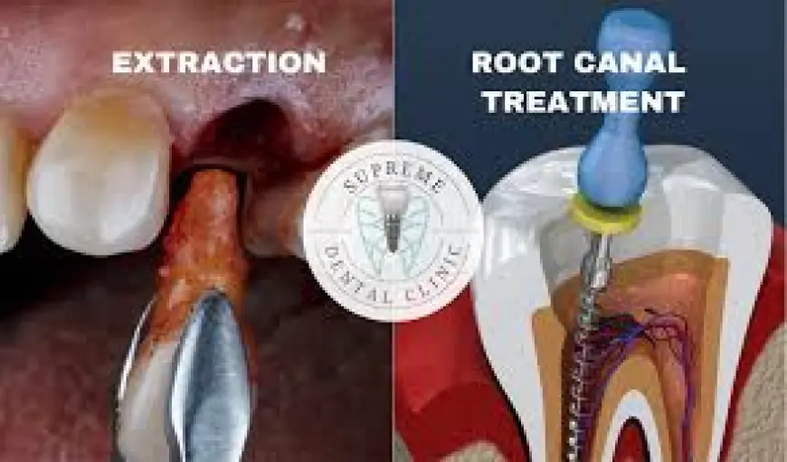 Is it better to get a root canal or extraction?