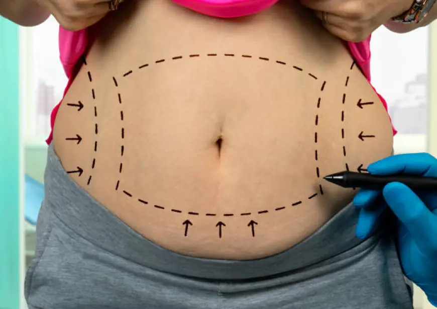 Can a Tummy Tuck Fix Loose Skin from Weight Loss?