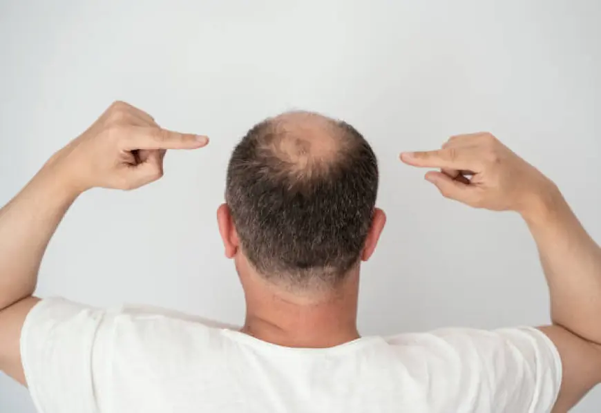 تعرف على أكثر تقنيات زراعة الشعر تطوراً في الرياض لعام 2025