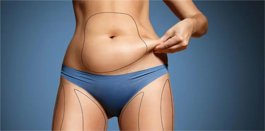 Abdominoplasty in Dubai: A Complete Guide to a Flatter Tummy