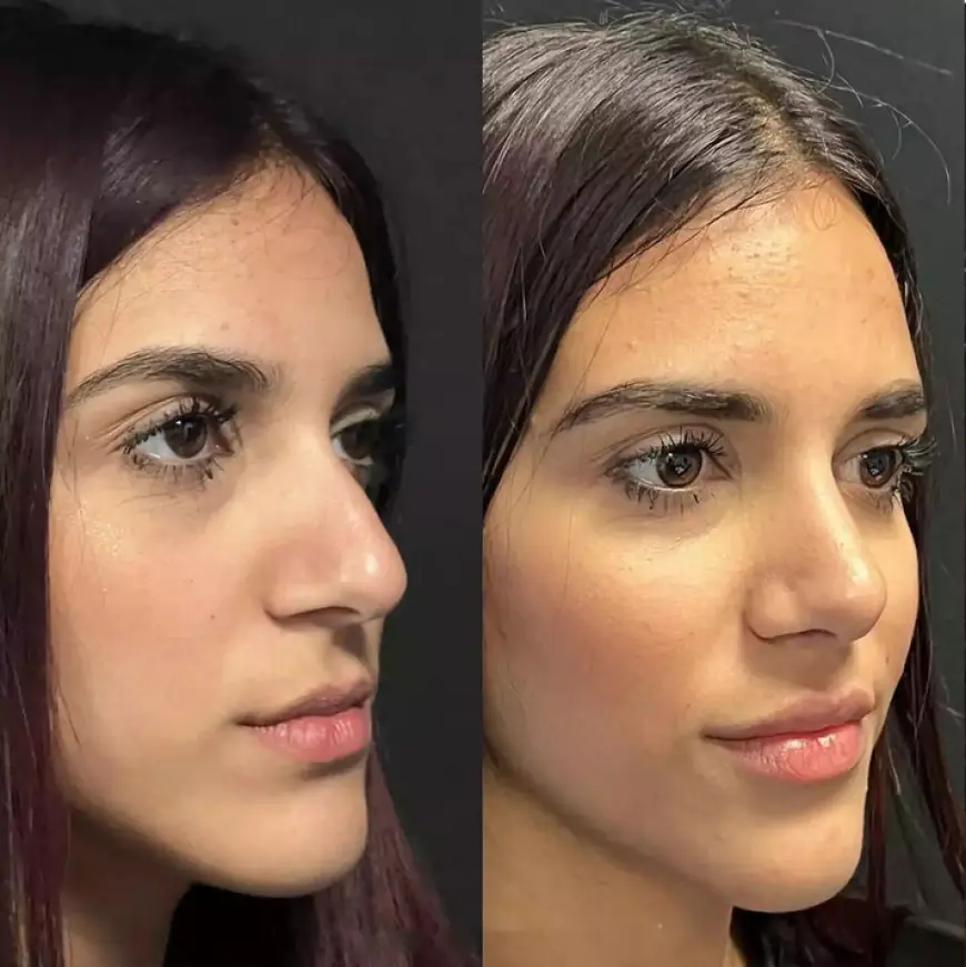 Best Septoplasty Surgeon in Dubai: How Do Patients Choose?