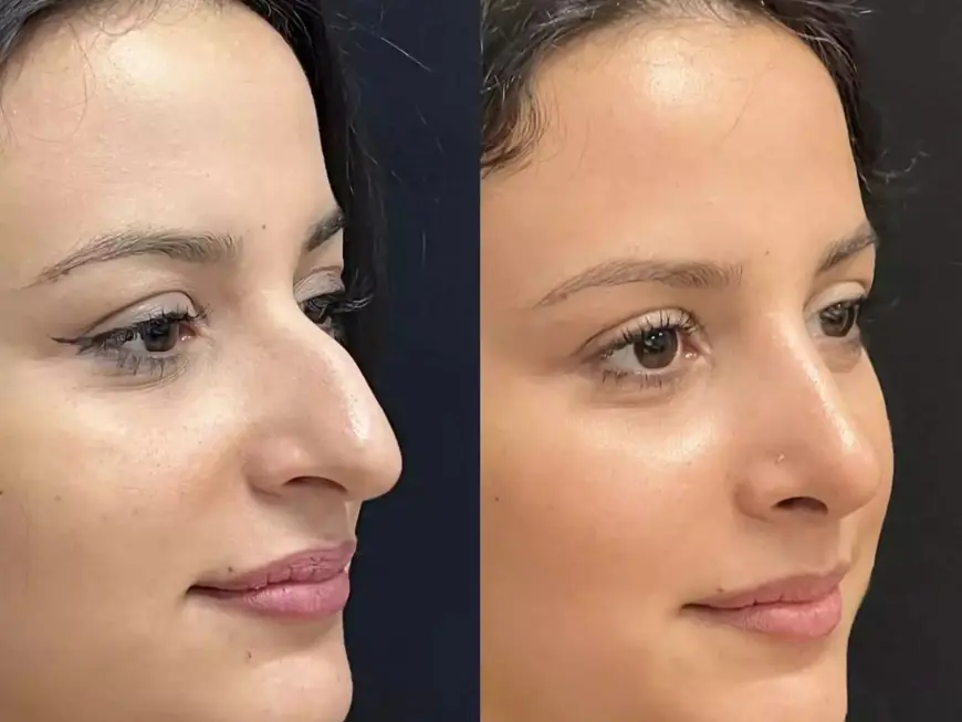 Best Rhinoplasty Surgeon in Dubai: How Do They Personalize Surgery?