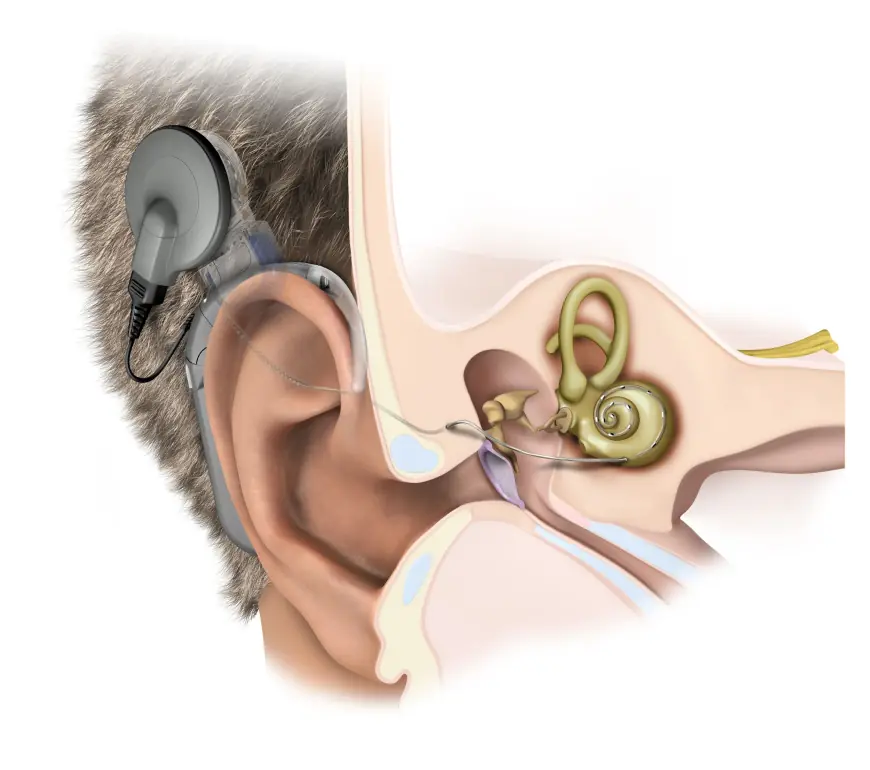 Audiological Devices Market Winning Strategies Leveraging Awareness, Affordability, and Digital Health Transformation
