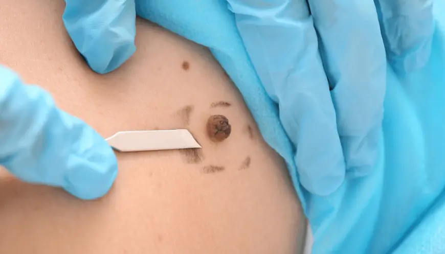 Does Skin Tag Removal Leave Scars?