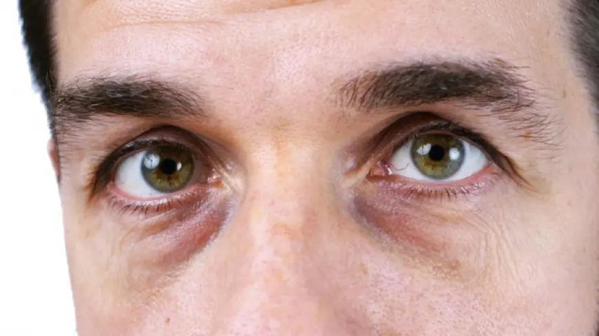 Can Dark Circles Treatment Work for Men Too?
