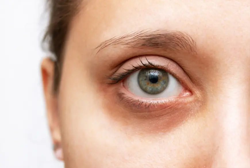 What Is the Best Dark Circles Treatment Today?