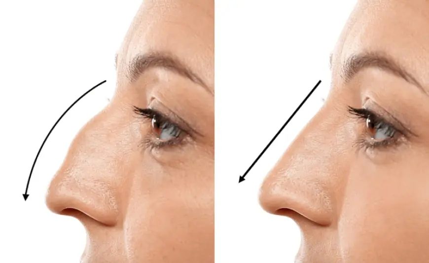 Before & After Rhinoplasty: Real Results That Inspire