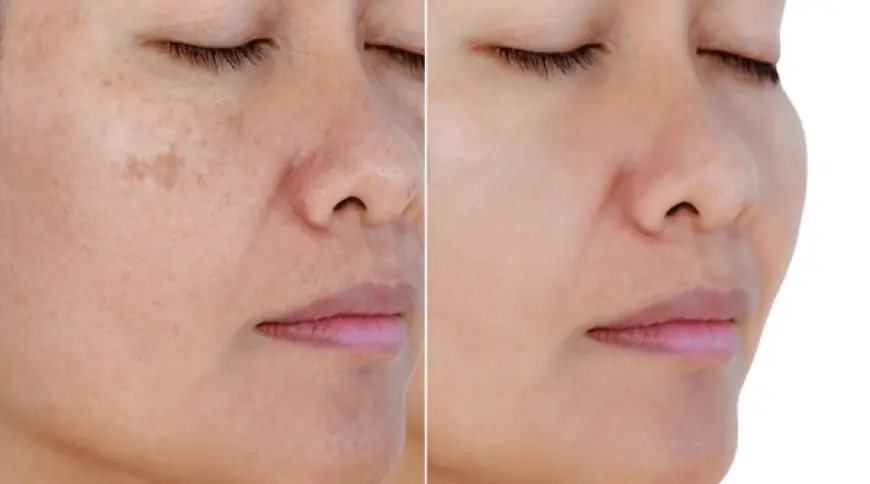 Complexion with Professional Skin Whitening Treatment in Islamabad