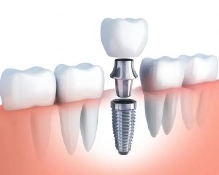 Missing Teeth? Get Dental Implants in Islamabad for a Natural Smile