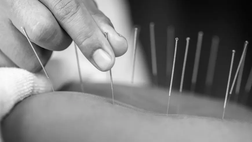 Acupuncture Caulfield: Natural Healing and Holistic Care for Your Health